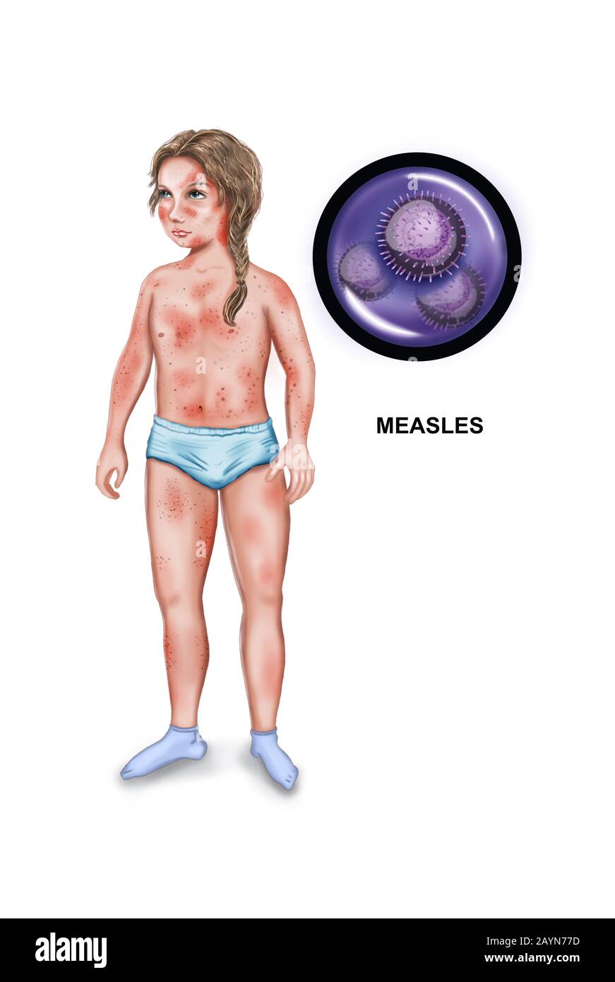 Roseole Banque D Image Et Photos Alamy