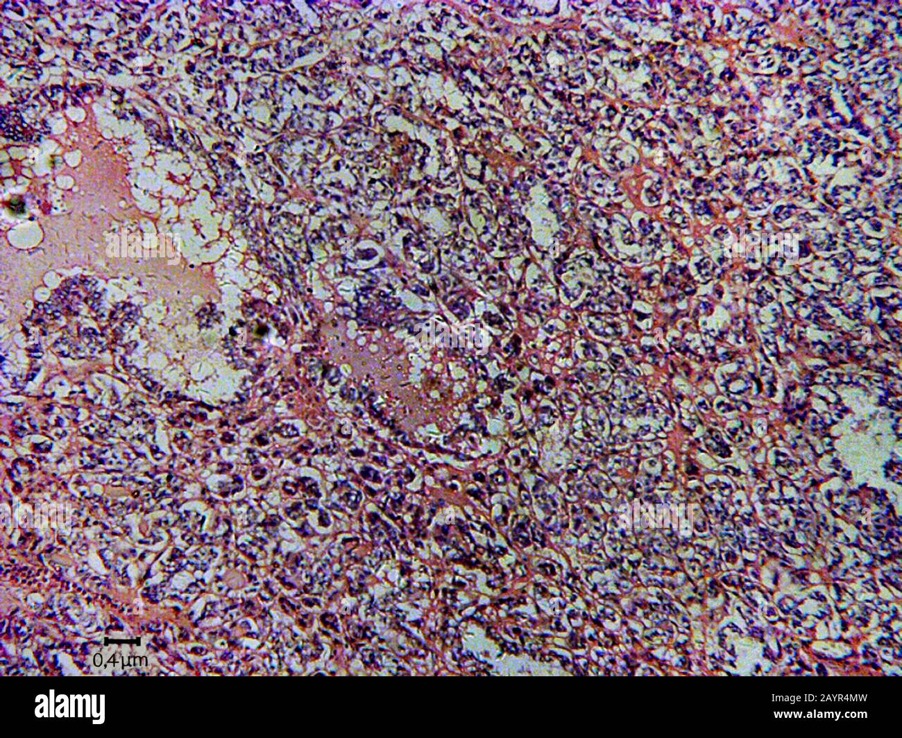 coupe histologique de tissu d'un cancer de la thyroïde effrayant, 500 x Banque D'Images