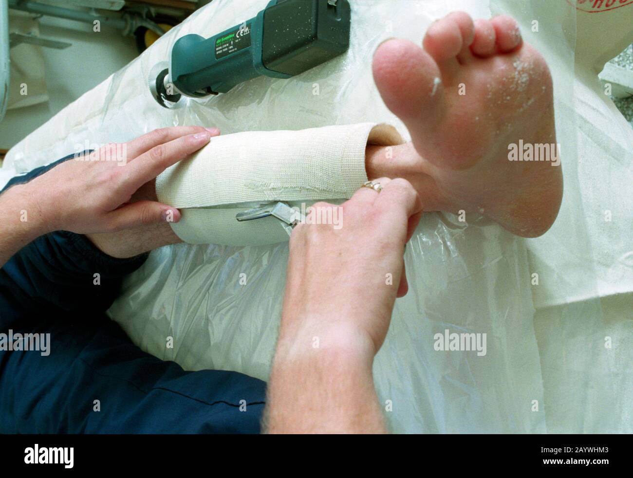Une fois qu'un plâtre est coupé dans A&E avec la scie de découpe de plâtre, l'infirmière coupe ensuite à travers le bandage en dessous avec une paire de ciseaux de bandage Banque D'Images