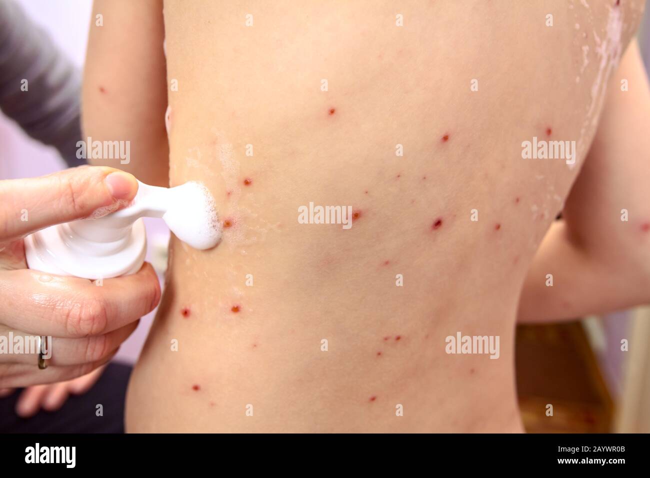 La peau de l'enfant infectés par la varicelle est d'avoir le traitement à  l'aide de mousse antiseptique Photo Stock - Alamy