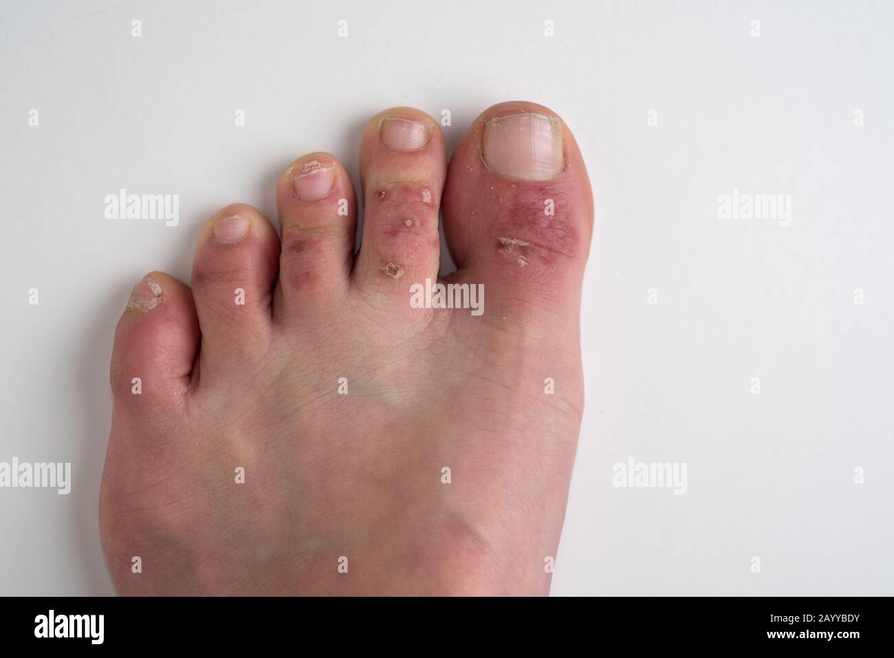Amman/ Jordanie - 05 février 2020, dermatite également connue et Eczema, provoquant une éruption cutanée, sécheresse, démangeaison sur les pieds d'une femme de 40 ans Banque D'Images