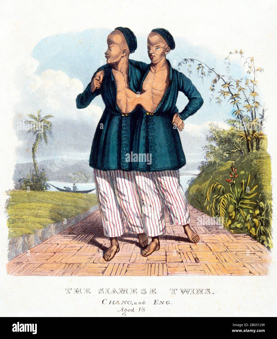 Chang et Eng Bunker (11 mai 1811 – 17 janvier 1874) étaient des frères jumeaux thaïlandais-américains dont la condition et le lieu de naissance sont devenus la base du terme 'jumeaux siamois'. Les frères Bunker sont nés le 11 mai 1811 dans la province de Samut Songkram, près de Bangkok, dans le Royaume de Siam (Thaïlande d'aujourd'hui). Leur père pêcheur était un Chinois thaïlandais, alors que leur mère était un Chinois malaisien. En raison de leur héritage chinois, ils étaient connus localement sous le nom de "Twins chinois". Les frères ont été joints au sternum par un petit morceau de cartilage, et bien que leurs foies aient été fusionnés, ils nous Banque D'Images