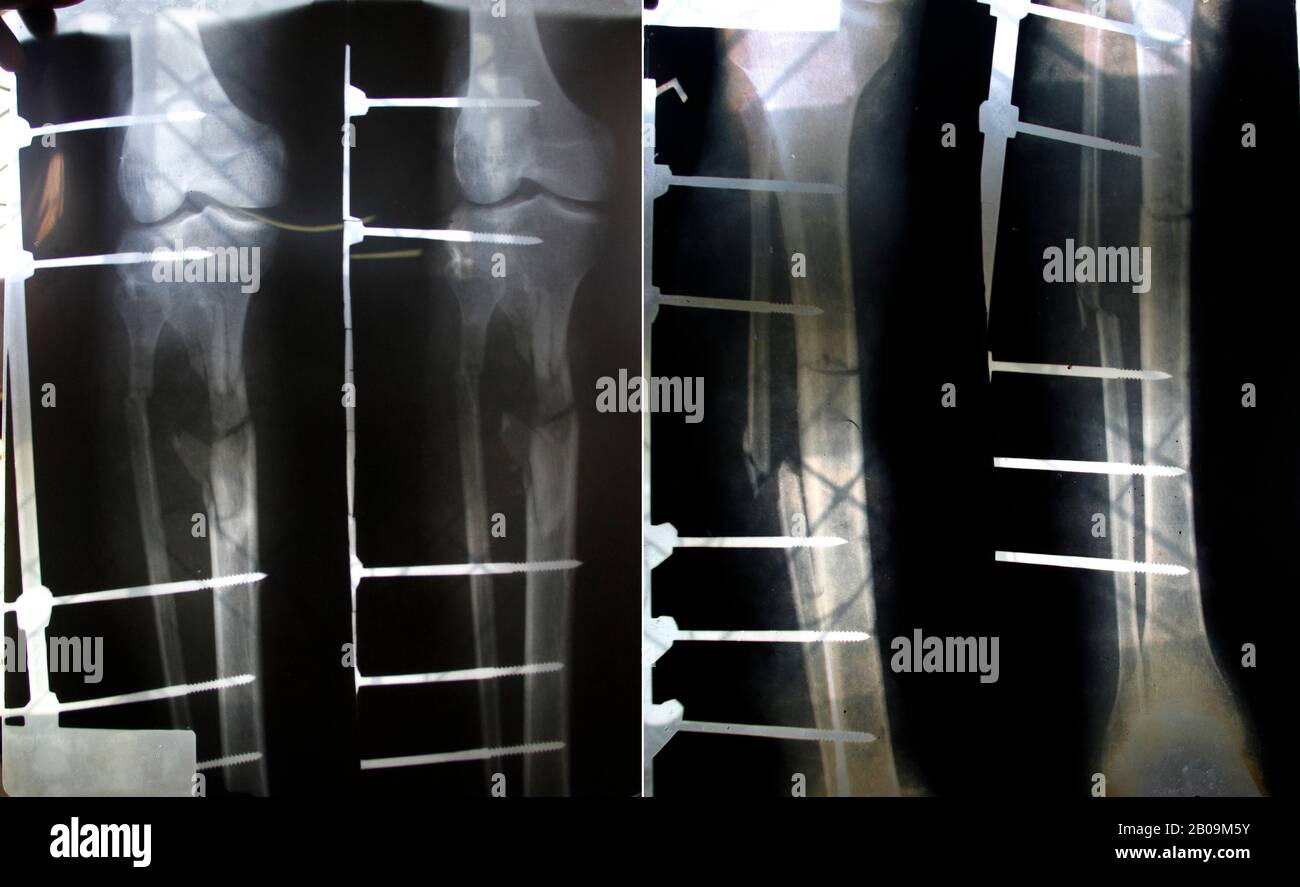 Film radiographique montrant la tibias fracturé et les fibulas de Fazal Mia et les ongles intramédullaires utilisés pour le traitement. Les jambes de Fazal Mia, âgé de 63 ans, ont été cassées lorsque le bus qu'il a roulé est entré en collision avec un tracteur à Kasba, Brahmanbaria, au Bangladesh. 28 Août 2011. Une des images de photo Story, Tears on Highways, de Noor Alam. Banque D'Images