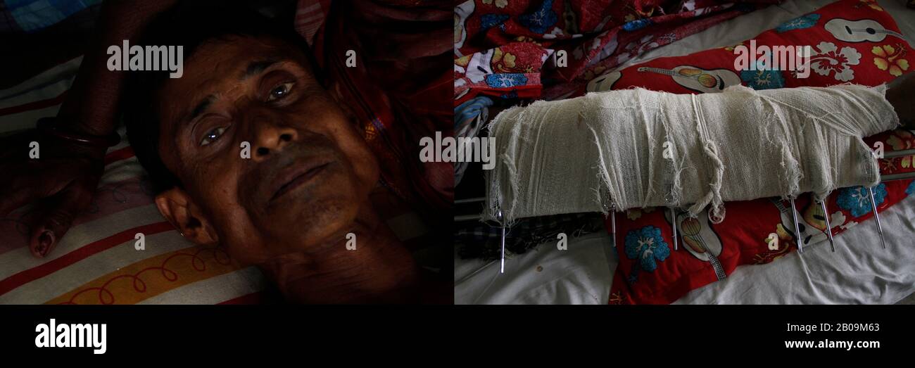 Des mains et une jambe de l'Islam Nurul, 45 ans, ont été fracturées dans un accident de bus à Rajshahi. « L'accident s'est produit en raison d'une course entre deux autobus sur la route. Près de cent mille taka ont déjà été dépensés pour le traitement et pourtant il faut plus. Comment un ouvrier de jour comme moi peut-il gérer de telles dépenses?" Santahar, Rajshahi, Bangladesh. 28 Août 2011. Une des images de photo Story, Tears on Highways, de Noor Alam. Banque D'Images
