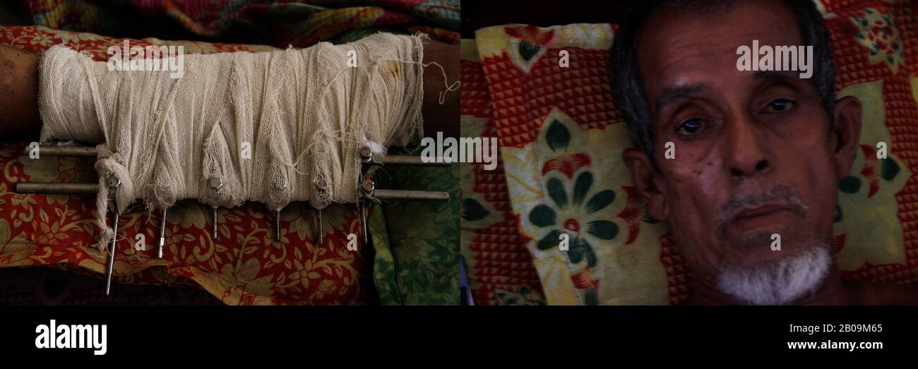 Les jambes de Fazal Mia, âgé de 63 ans, ont été cassées lorsque le bus qu'il a roulé est entré en collision avec un tracteur à Kasba, Brahmanbaria, au Bangladesh. 28 Août 2011. Une des images de photo Story, Tears on Highways, de Noor Alam. Banque D'Images