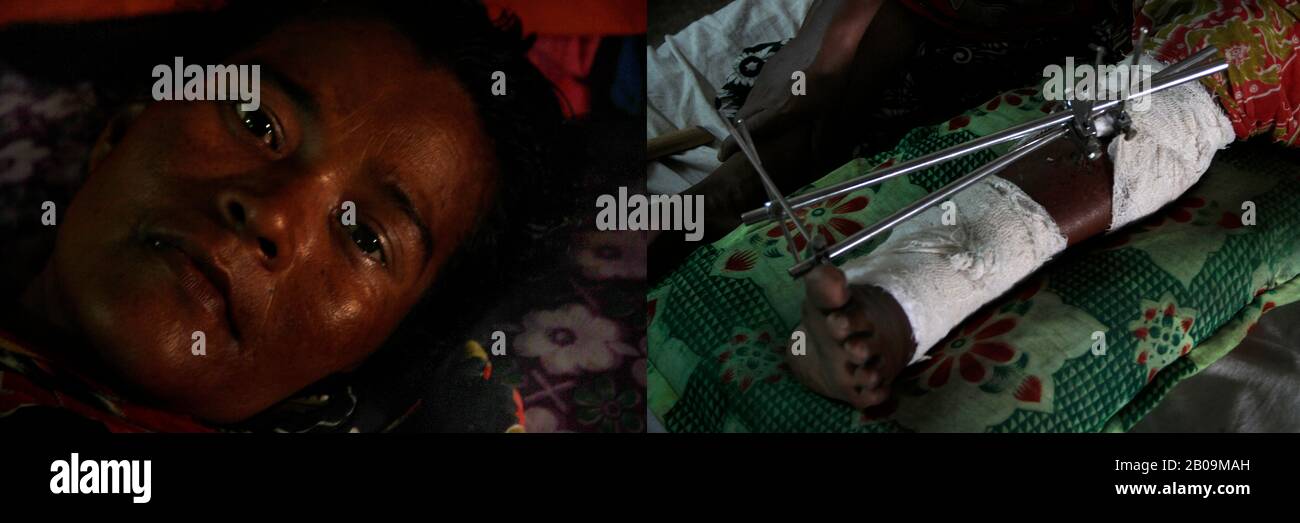 Khaimon Begum, 41 ans, a été hospitalisée à Dhaka après avoir été frappée par un "Nocimon" (tracteur, construit localement avec une machine à pompe de puissance) en traversant une route à Rangni, Meherpur. "J’ai dû faire une chirurgie qui a nécessité cinq poches de sang. Pourtant, le sang est nécessaire pour plus de chirurgies. Je n'ai pas de parent à Dhaka. Comment dois-je me permettre les opérations chirurgicales ? Dhaka, Bangladesh. 29 Août 2011. Une des images de photo Story, Tears on Highways, de Noor Alam. Banque D'Images