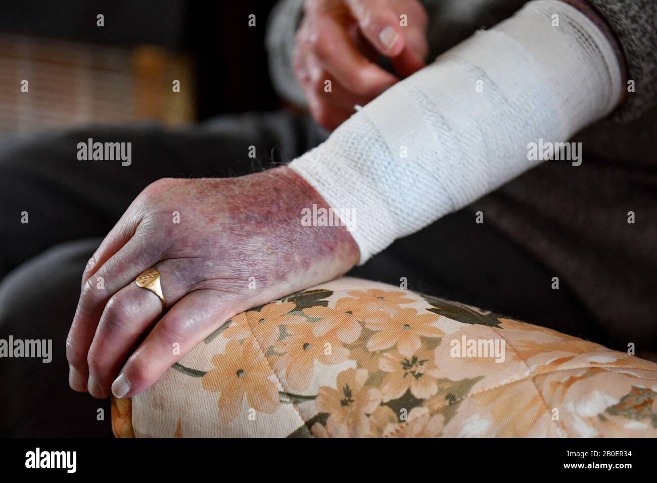 John Cox, 102 ans, montre les blessures qu'il a subies, après avoir combattu un conman cambrioleur qui a essayé d'accéder à sa maison à Lincoln, mardi. Banque D'Images