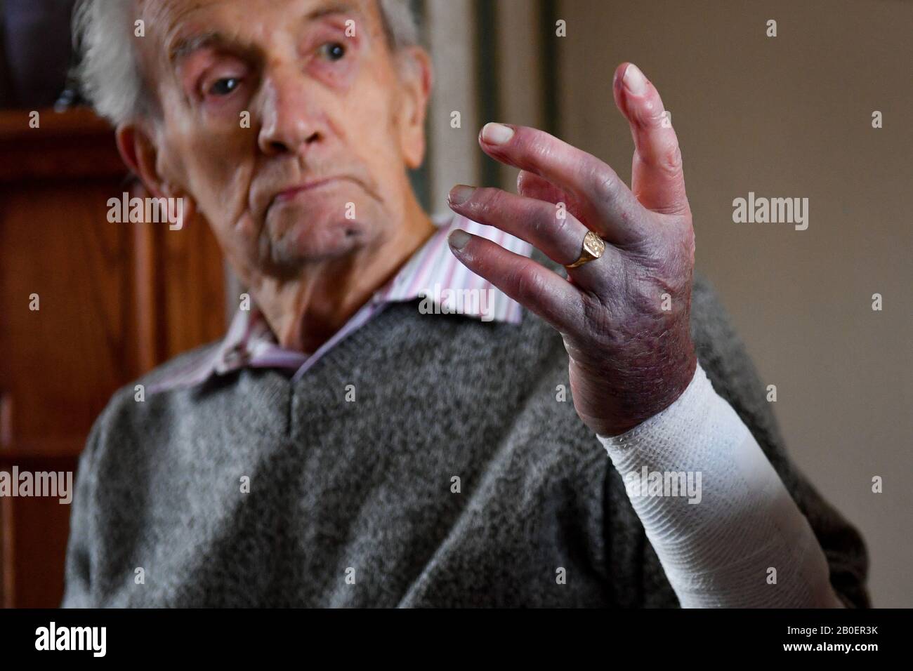 John Cox, 102 ans, montre les blessures qu'il a subies chez lui à Lincoln, après avoir combattu un conman burglar qui a essayé d'obtenir l'accès mardi. Banque D'Images