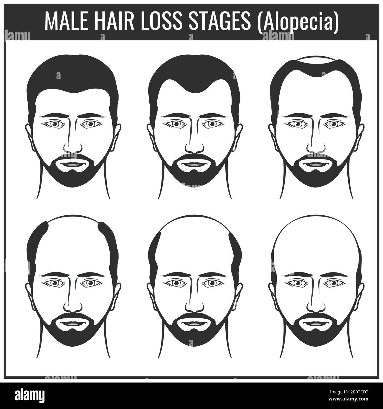 Stades de perte de cheveux et types de calvitie. Graphiques vectoriels de problèmes de poils d'homme. Problème avec les cheveux, illustration de la perte de cheveux Illustration de Vecteur