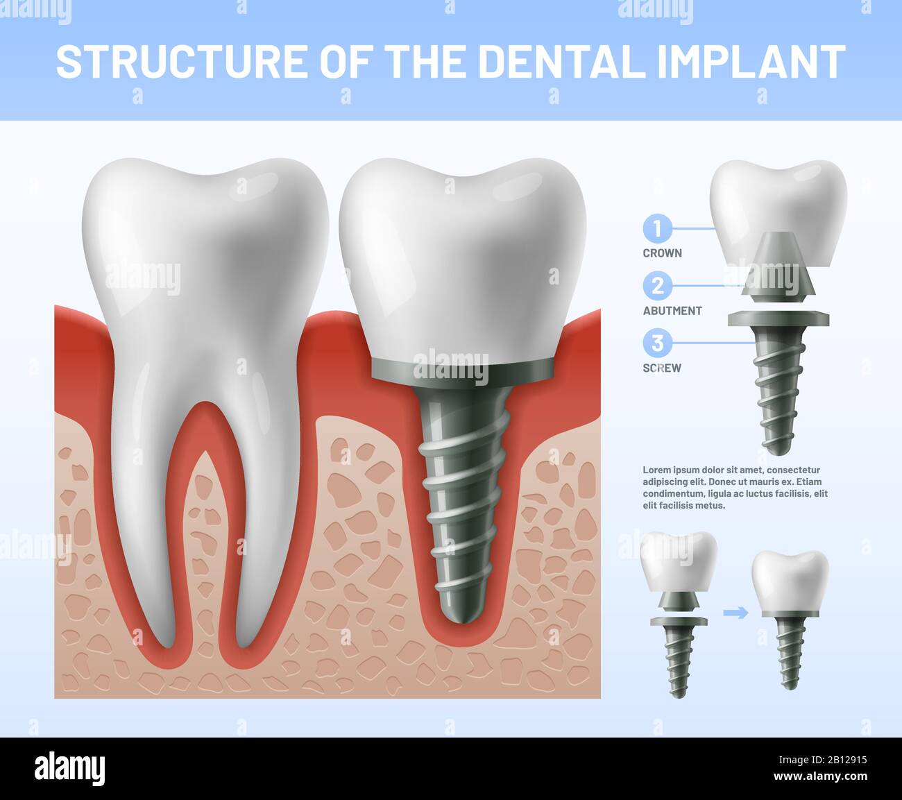 Implant dentaire. Procédure d'implantation ou piliers de couronne dentée. Illustration vectorielle des soins de santé Illustration de Vecteur