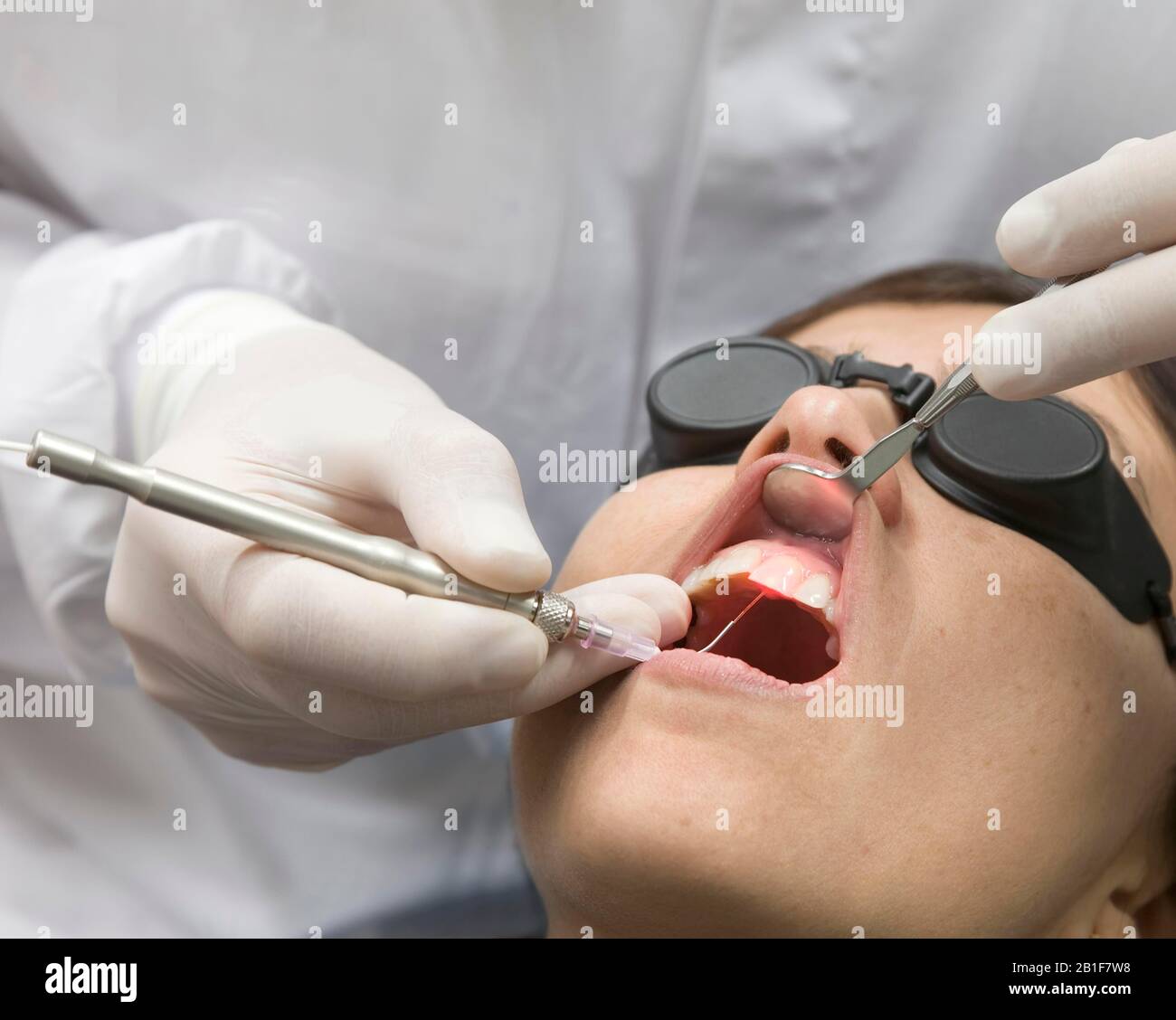 Soins dentaires avec laser, technologie laser, Allemagne Banque D'Images
