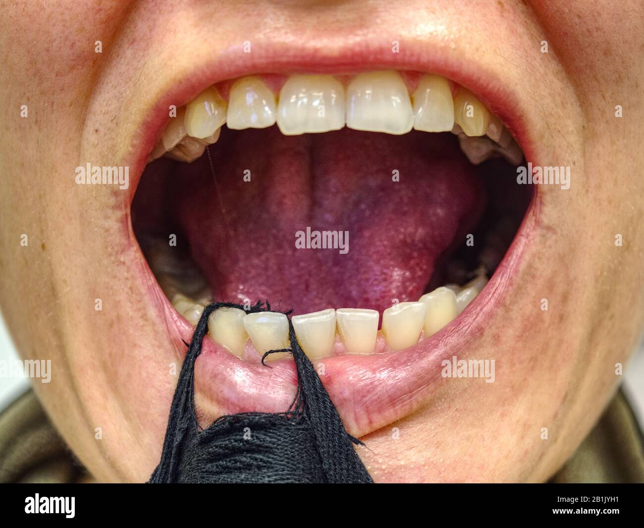 La femme ouvre la bouche avec une bande de textile et montre ses dents coudées et pourries. Lèvre sèche à dents jaunes coudées à bouche ouverte femelle Banque D'Images