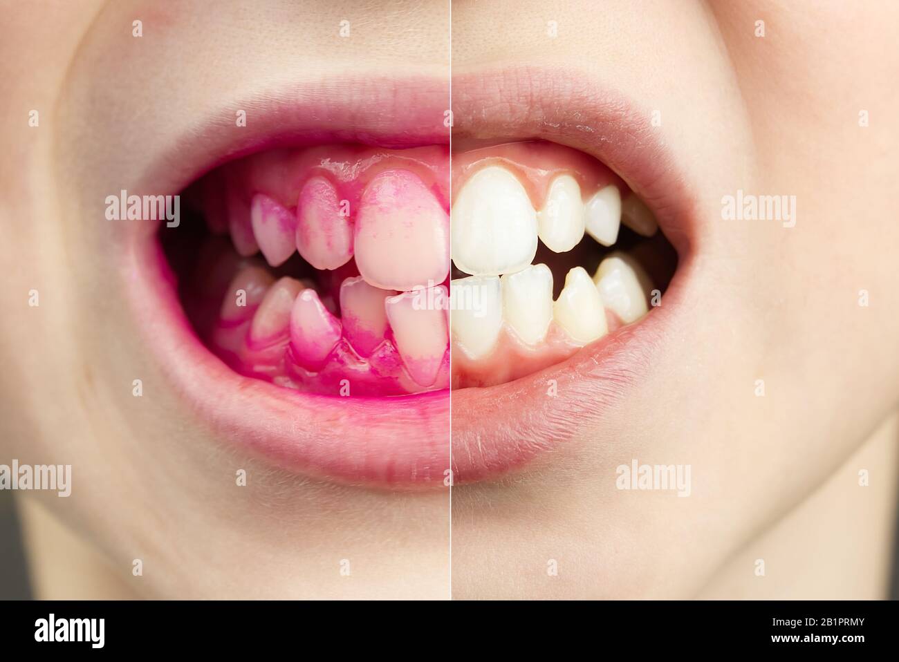 Plaque révélant les comprimés au travail. Avant et après - effet. Gros plan photo de la dent de jeune garçon. Concept de pilule dentaire Banque D'Images