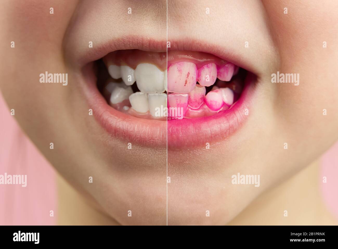 Plaque révélant les comprimés au travail. Avant et après - effet. Gros plan photo de jeune fille dent. Concept de pilule dentaire Banque D'Images