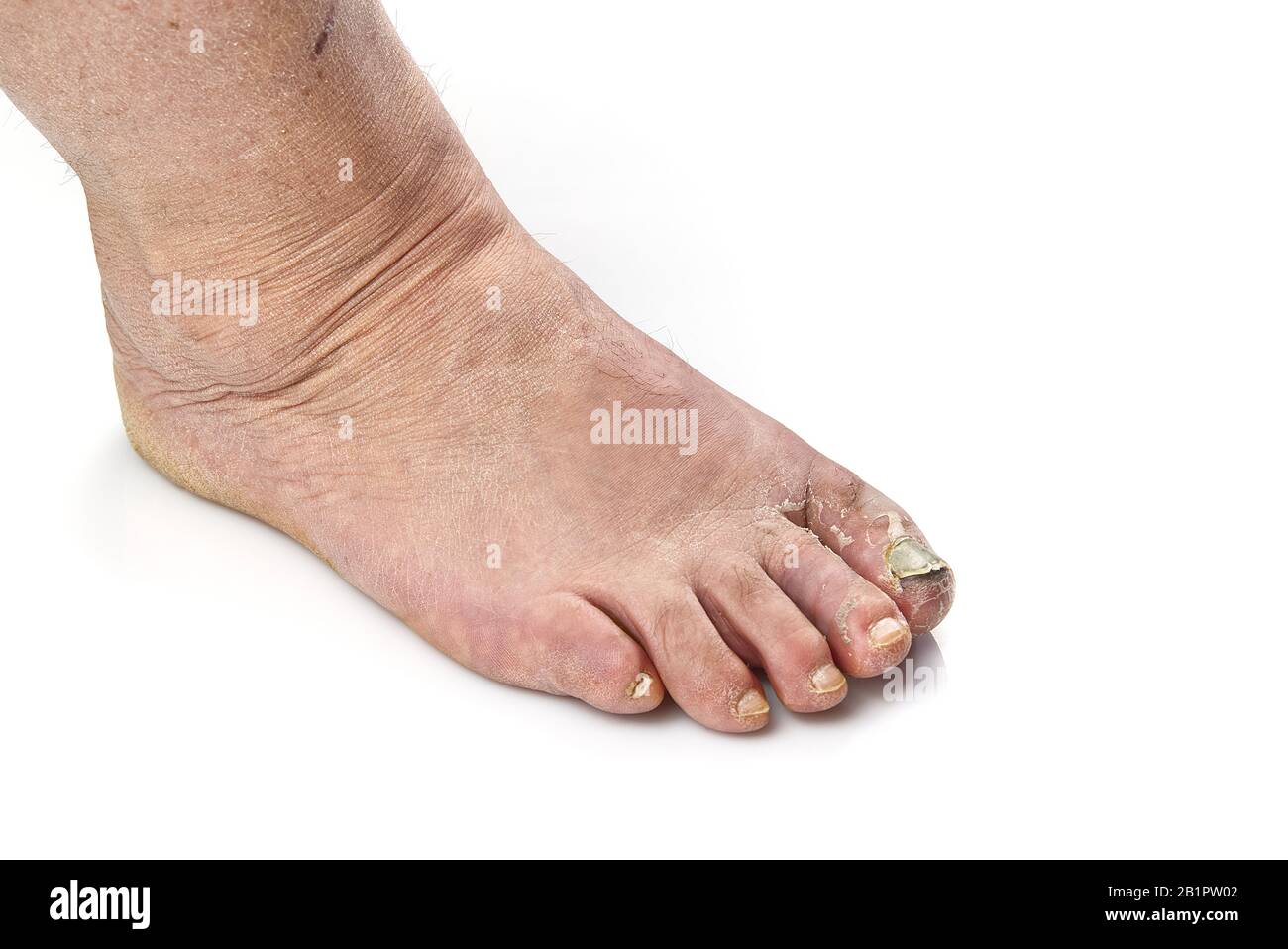 Ongle Incarne Banque D Image Et Photos Alamy