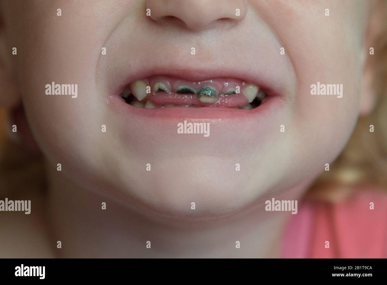 Les dents avant du bébé ne sont pas saines avec une plaque noire et des caries Banque D'Images