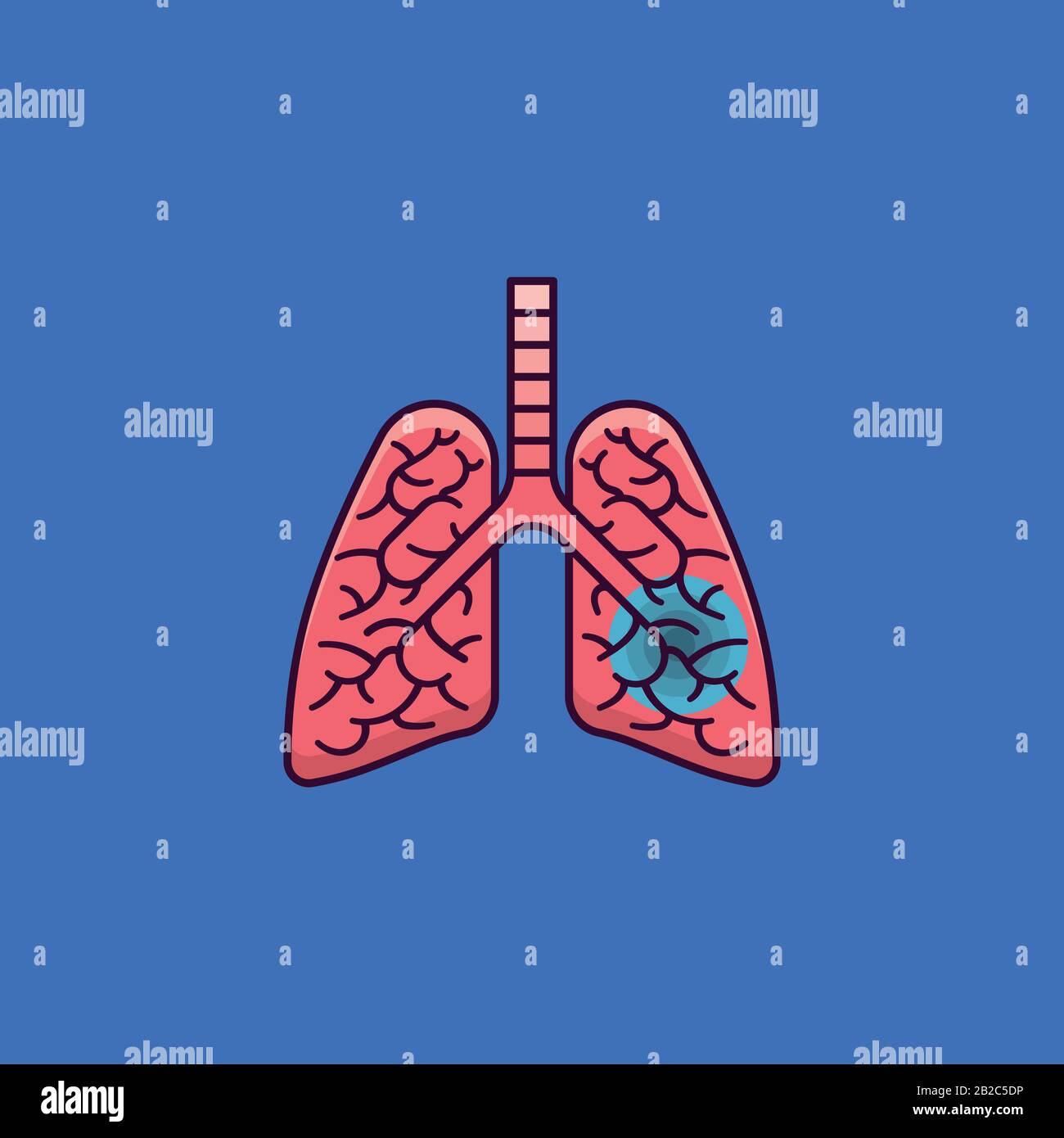Illustration vectorielle des poumons humains infectés pour la Journée de la tuberculose le 24 mars. Symbole de couleur des maladies pulmonaires graves. Illustration de Vecteur