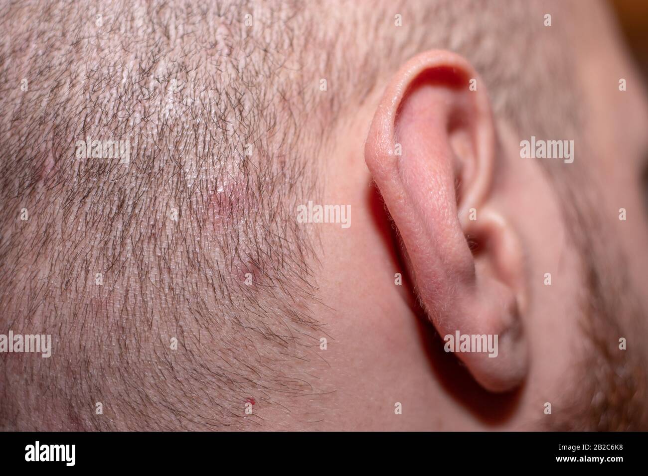 Vue latérale avec l'oreille en vue d'un homme avec des cheveux courts  souffrant de l'acné de cuir chevelu. Petits points rouges iritant la peau  causant des problèmes de peau d'éruption Photo Stock -