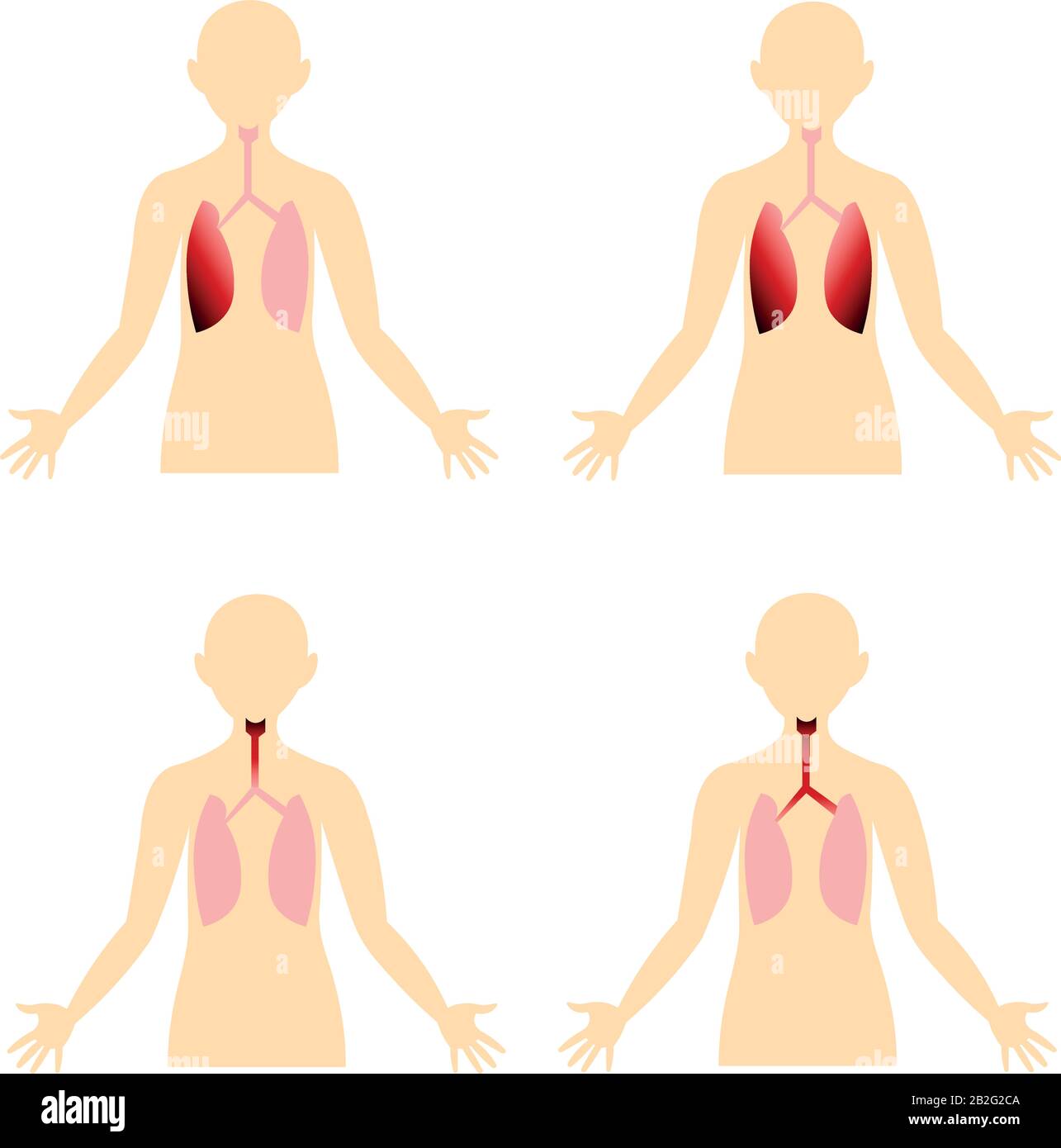Maladies du système respiratoire. Organes du corps humain. Image anatomique. Pneumonie, bronchite. Illustration de Vecteur