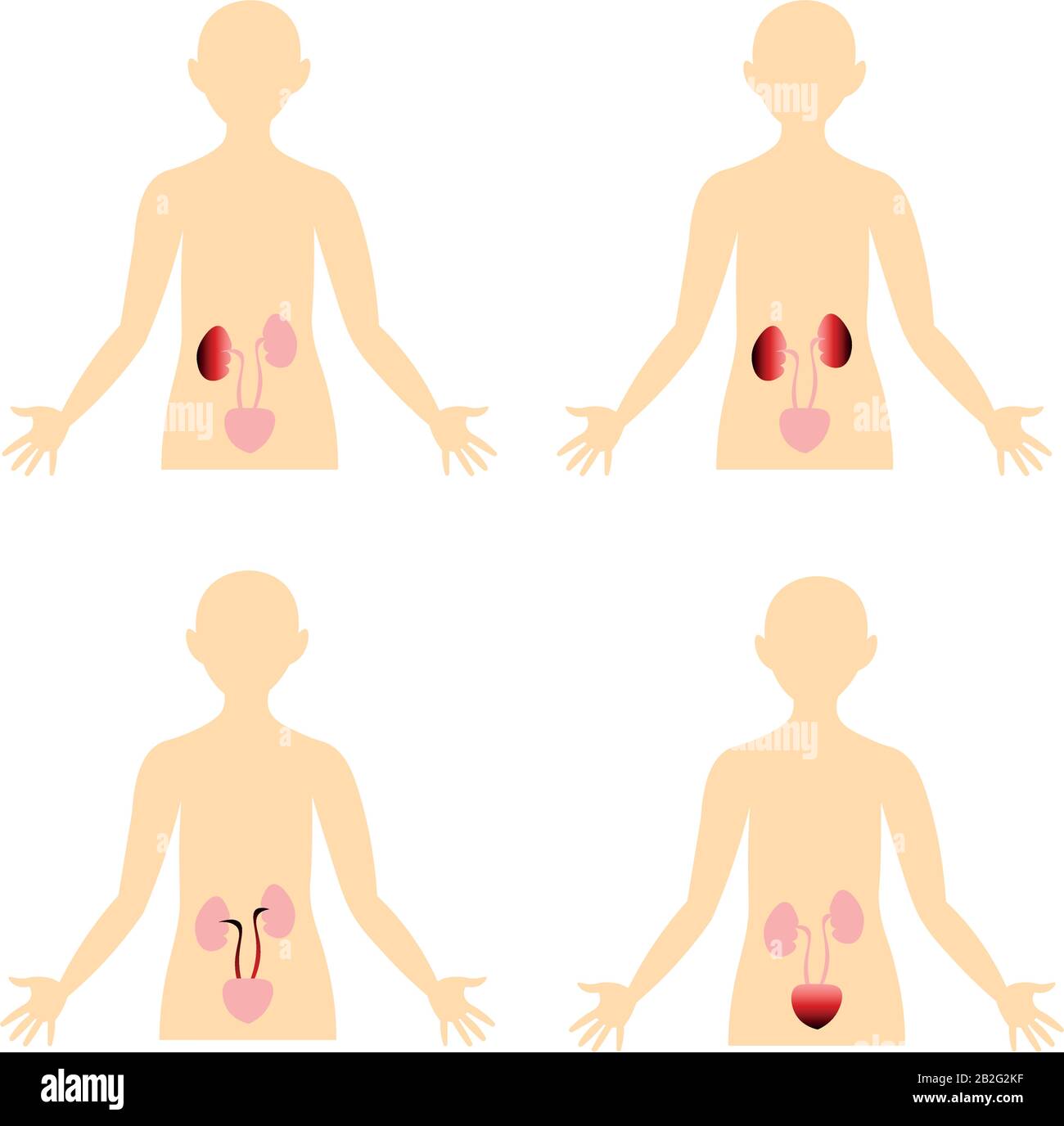 Maladies du système urinaire. Schéma du corps humain. Image anatomique. Inflammation, infection. Illustration de Vecteur