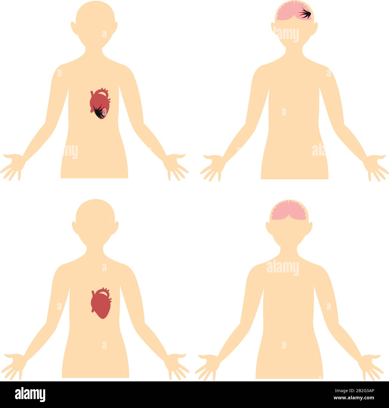 Crise cardiaque, AVC, thrombose. Maladies du cerveau et du cœur. Anatomie. Schéma du corps humain. Illustration de Vecteur
