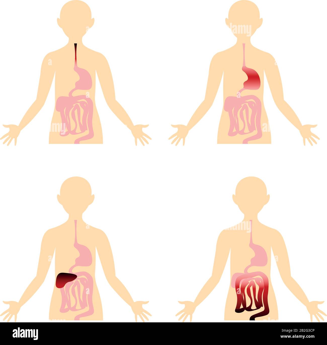 Maladies du système digestif. Organes du corps humain. Image anatomique. Gastrite, ulcères, cirrhose, hépatite. Illustration de Vecteur
