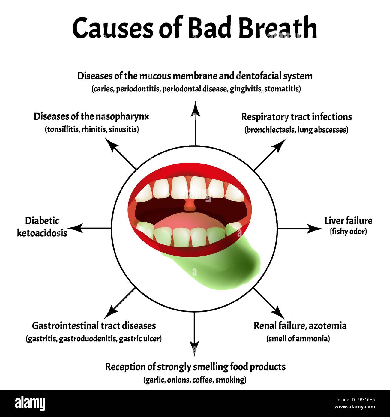 Causes de mauvaise respiration. Halose. La structure des dents et de la cavité buccale. Maladies des dents. Infographies. Illustration vectorielle sur isolée Illustration de Vecteur