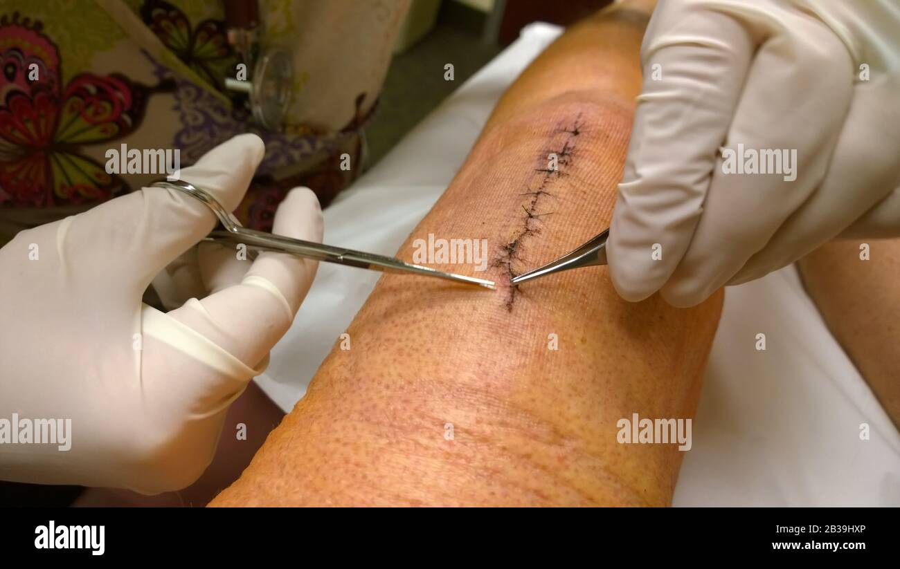 Après une opération réelle du genou, les points de suture et les agrafes sont extraits par un médecin avec des gants et des brucelles Banque D'Images