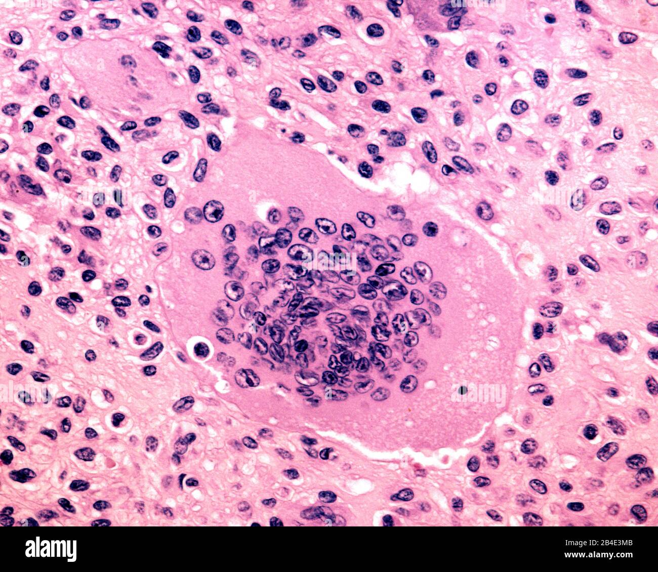 Cellule géante mutinucléée dérivée des ostéoclastes. Biopsie d’une tumeur osseuse à cellules géantes humaines. Micrographe lumineux. Banque D'Images