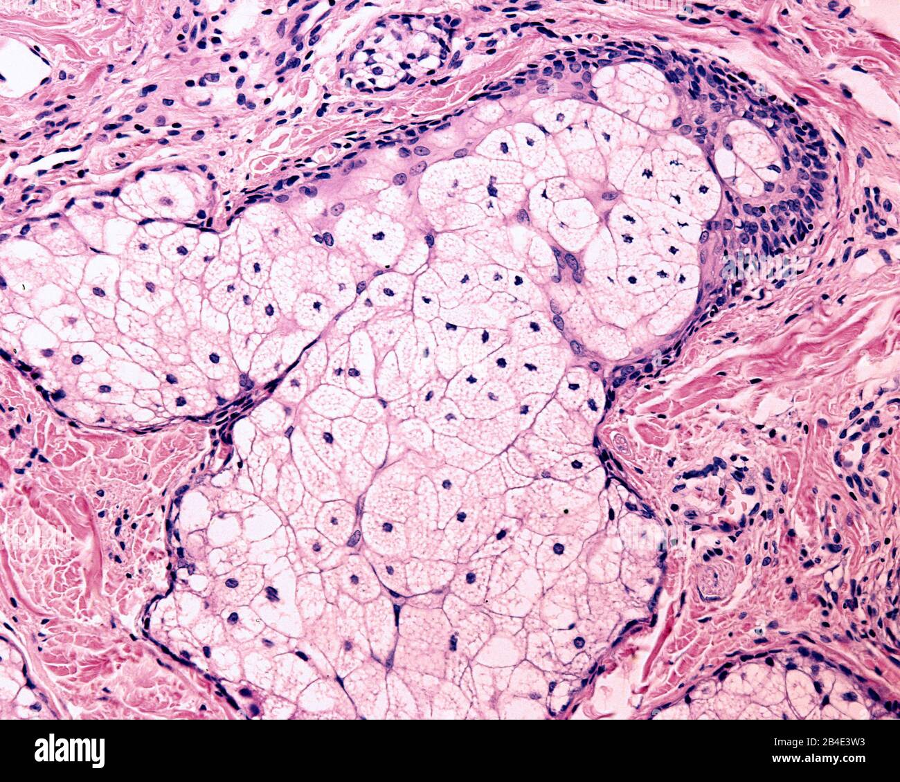 La glande sébacée est une glande holocrine qui sécrète le sébum. Les cellules accumulent des gouttelettes d'huile comme vacuoles claires. Enfin, les cellules meurent, qui est dans Banque D'Images