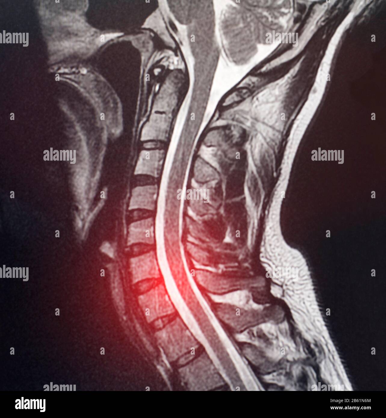 Image par résonance magnétique de la colonne cervicale d'un patient qui a la douleur et l'engourdissement dans le cou. Le concept de diagnostic et de traitement du col de l'utérus Banque D'Images