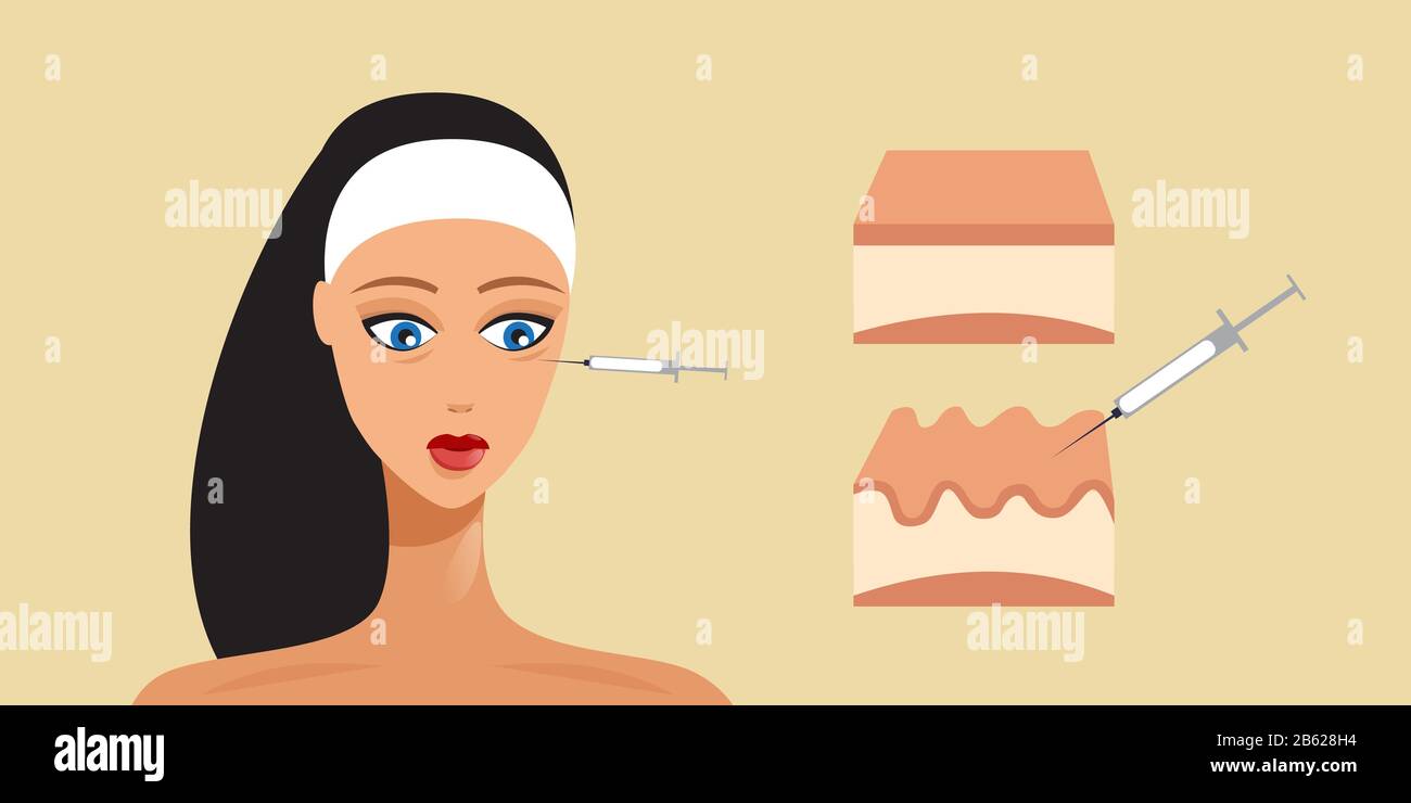 acide hyaluronique injection faciale couche de peau beauté cosmétologie anti-vieillissement femme rajeunissement mésothérapie concept portrait illustration vectorielle horizontale Illustration de Vecteur