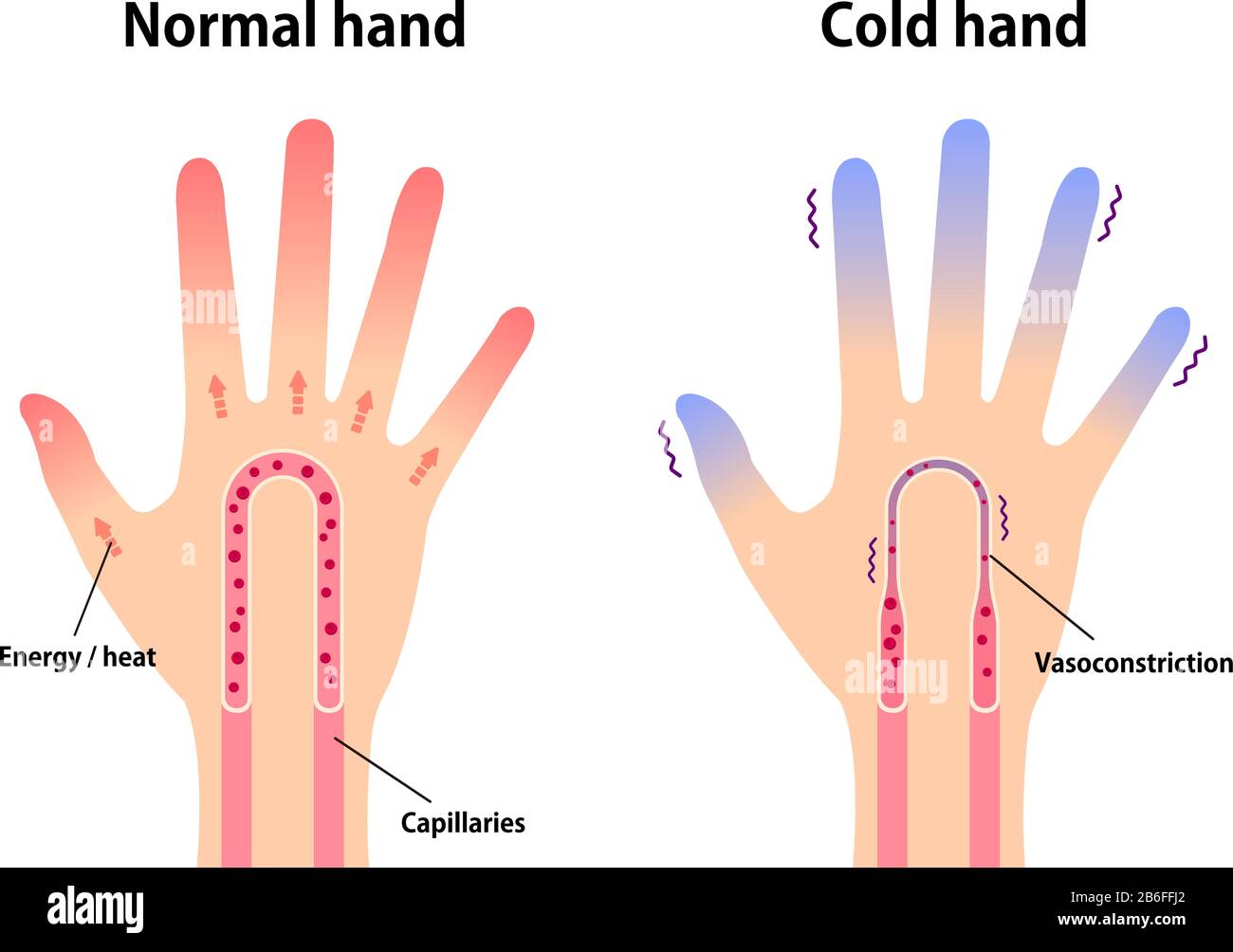 Illustration de comparaison de la main normale et de la main froide ( sensibilité au bout des doigts froid et froid) Illustration de Vecteur