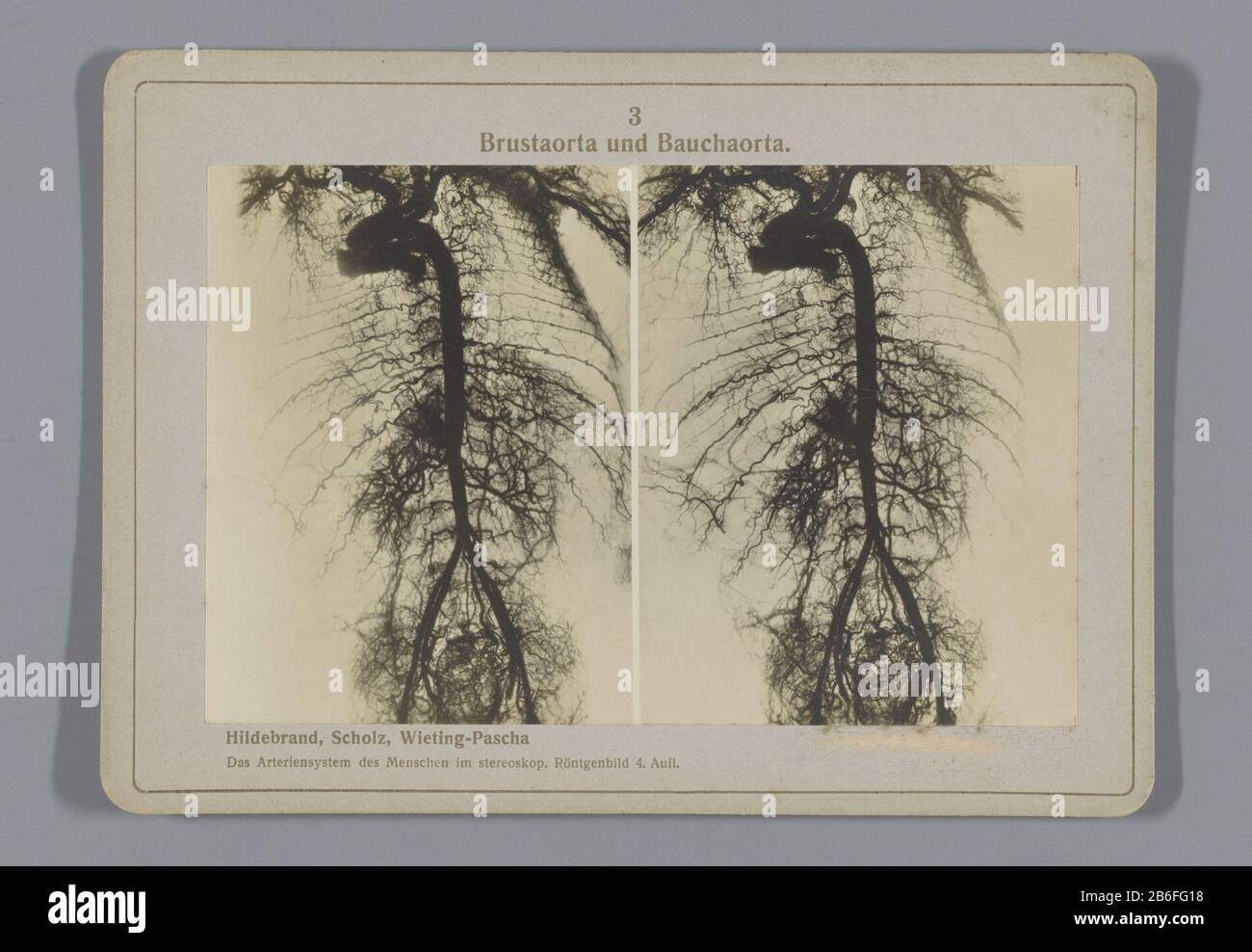 Aorte thoracique et aorte abdominale Broust aortique et Bauchaorta Type d'objet : photo stéréo Numéro d'article: RP-F F26535 Fabricant : Photographe: JF Bergman Date: 1900 - 1940 Caractéristiques physiques: Photographie sur carton: Carton: Technique: Photographie Dimensions: Milieu secondaire: H 75 mm × W 150 mm Banque D'Images