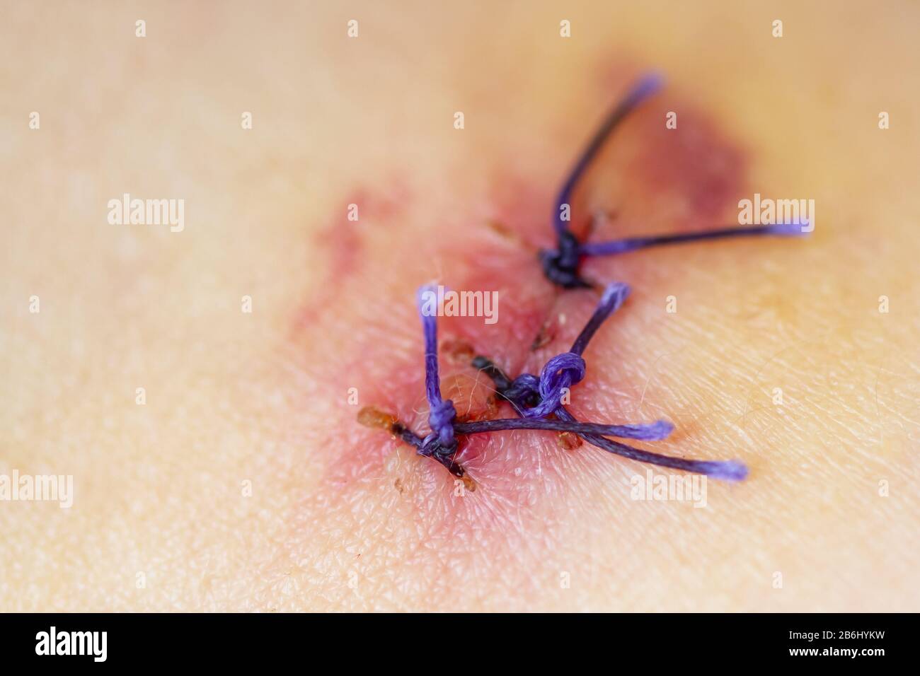 Cicatrice de la suture de l'opération avec une fibre bleue. Cicatrice après l'enlèvement chirurgical d'une marque de naissance. Gros plan, mise au point sélective Banque D'Images