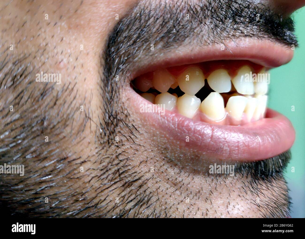 Un homme avec une barbe montre ses dents, il a un écart de dent. Banque D'Images