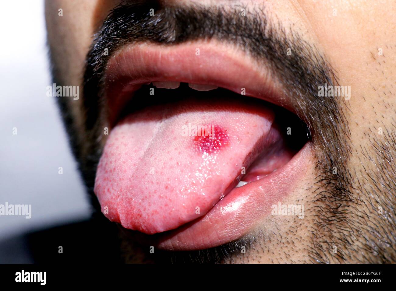 Une fermeture d'une langue malade dans laquelle un spot rouge se dissimule. Brûlure et inconfort de la langue Banque D'Images