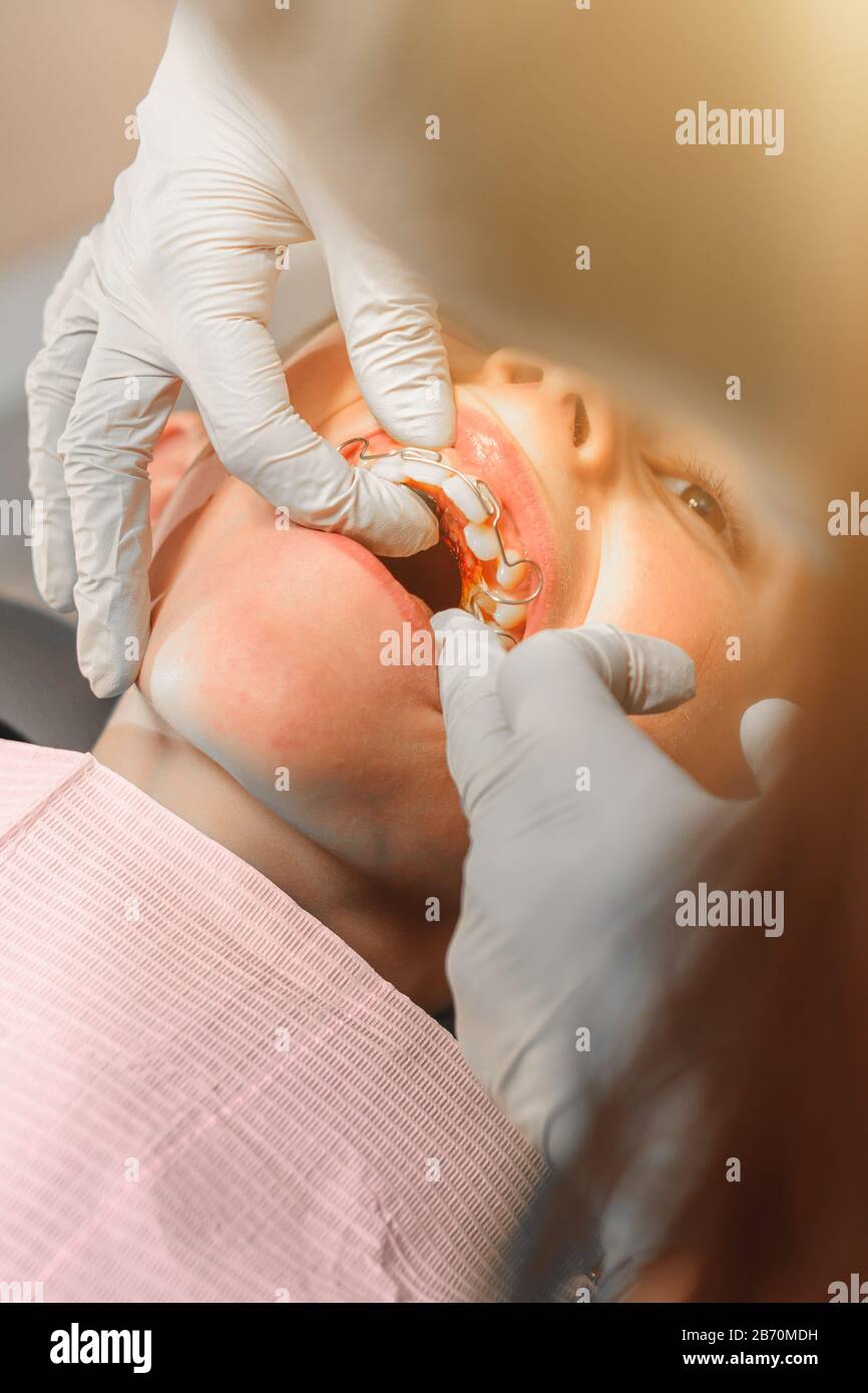 Le garçon avec sa bouche ouverte se trouve dans la chaise du dentiste alors que l'orthodontiste tient la plaque sur ses dents.2020 Banque D'Images