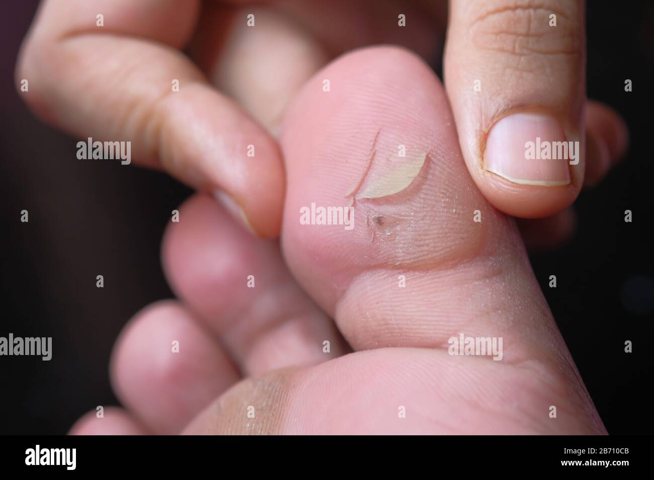 Maladie et deformation des ongles Banque de photographies et d'images à  haute résolution - Alamy