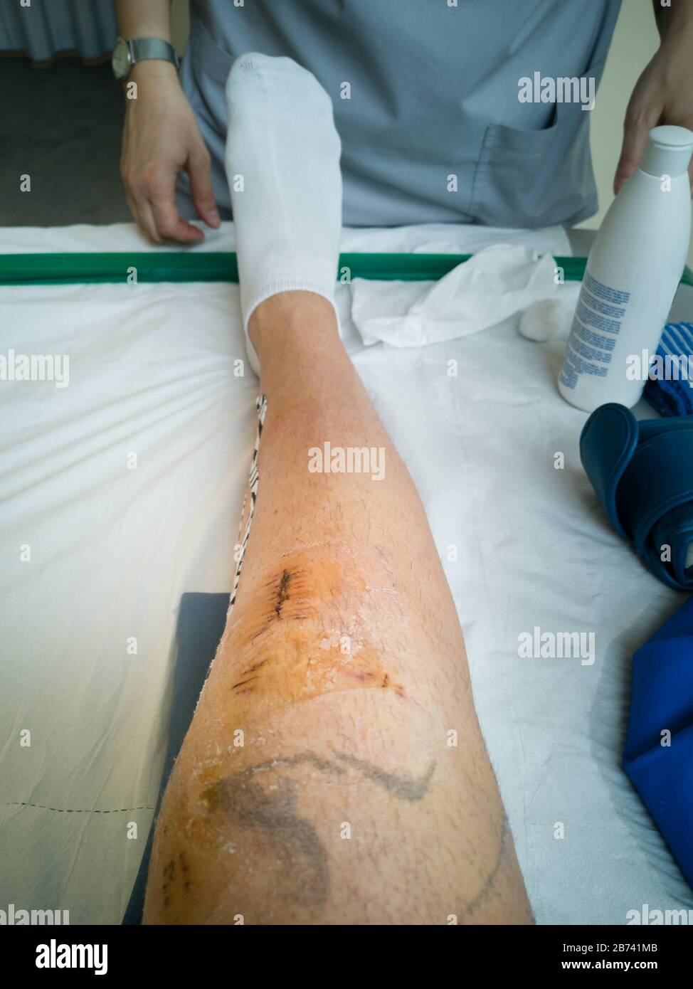 Lésion du genou après l'élimination des points de piqûre après la chirurgie du genou. Banque D'Images