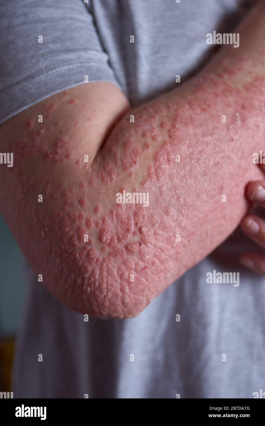 Vue avant-bras de la femme avec la psoriasis Photo Stock - Alamy