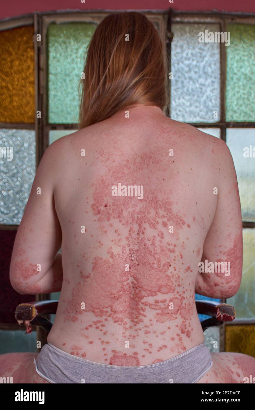 Dos de femme avec psoriasis assis sur une chaise Banque D'Images