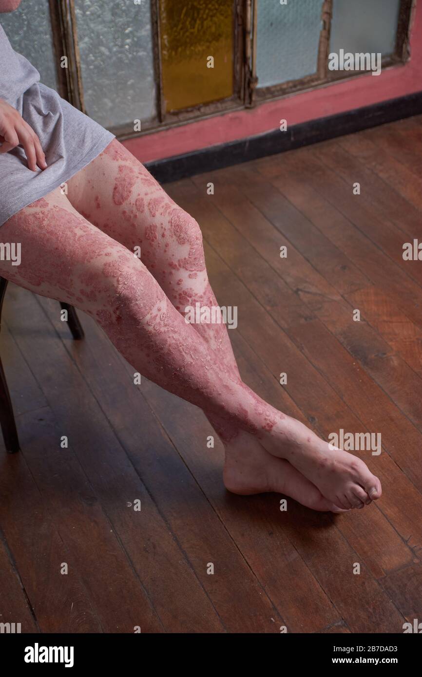 Vue sur la jambe et les pieds de la femme avec la psoriasis Banque D'Images