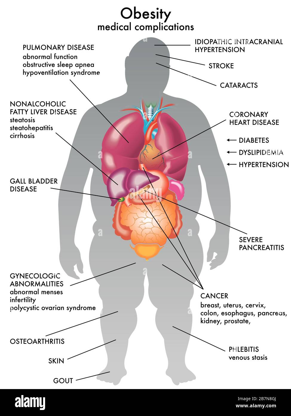 Illustration médicale des conséquences de l'obésité. Banque D'Images