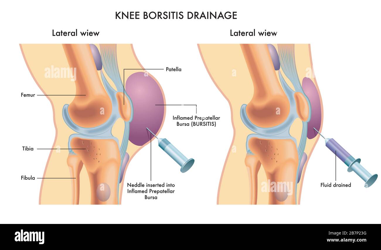 Illustration médicale marquée montrant la procédure de drainage de la bursite du genou. Banque D'Images