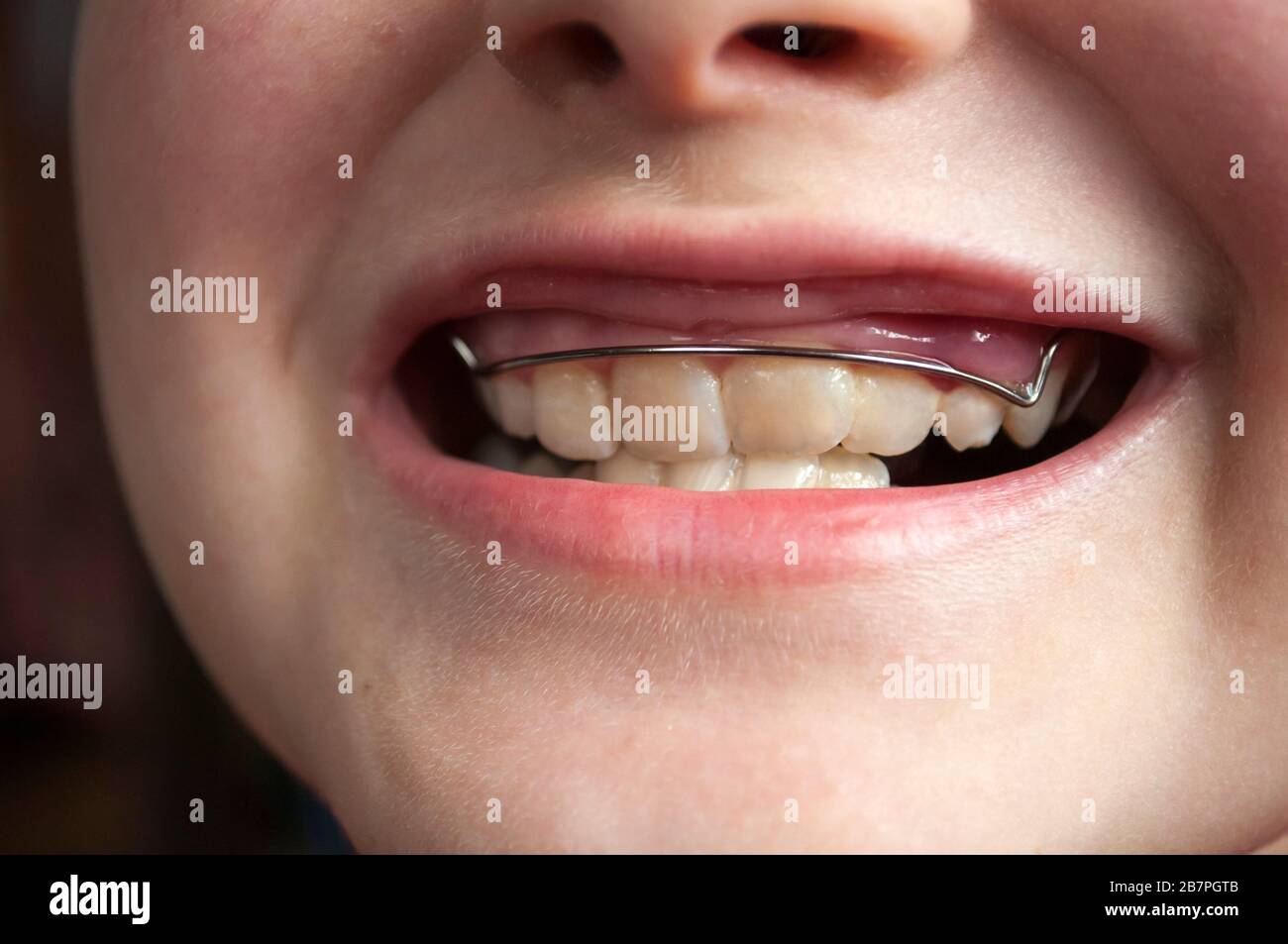 Défauts de la mâchoire, dents cousues chez un enfant de 9 ans, dents nécessitant une correction de la morsure.Bite avec pièces de retenue orthodontiques. Gros plan Banque D'Images