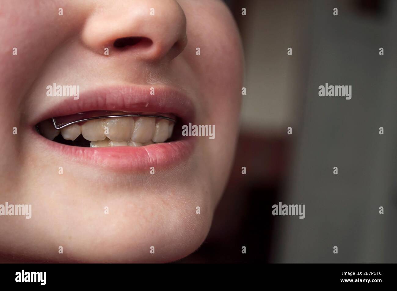 Défauts de la mâchoire, dents cousues chez un enfant de 9 ans, dents nécessitant une correction de la morsure.Bite avec plaque orthodontique. Gros plan Banque D'Images