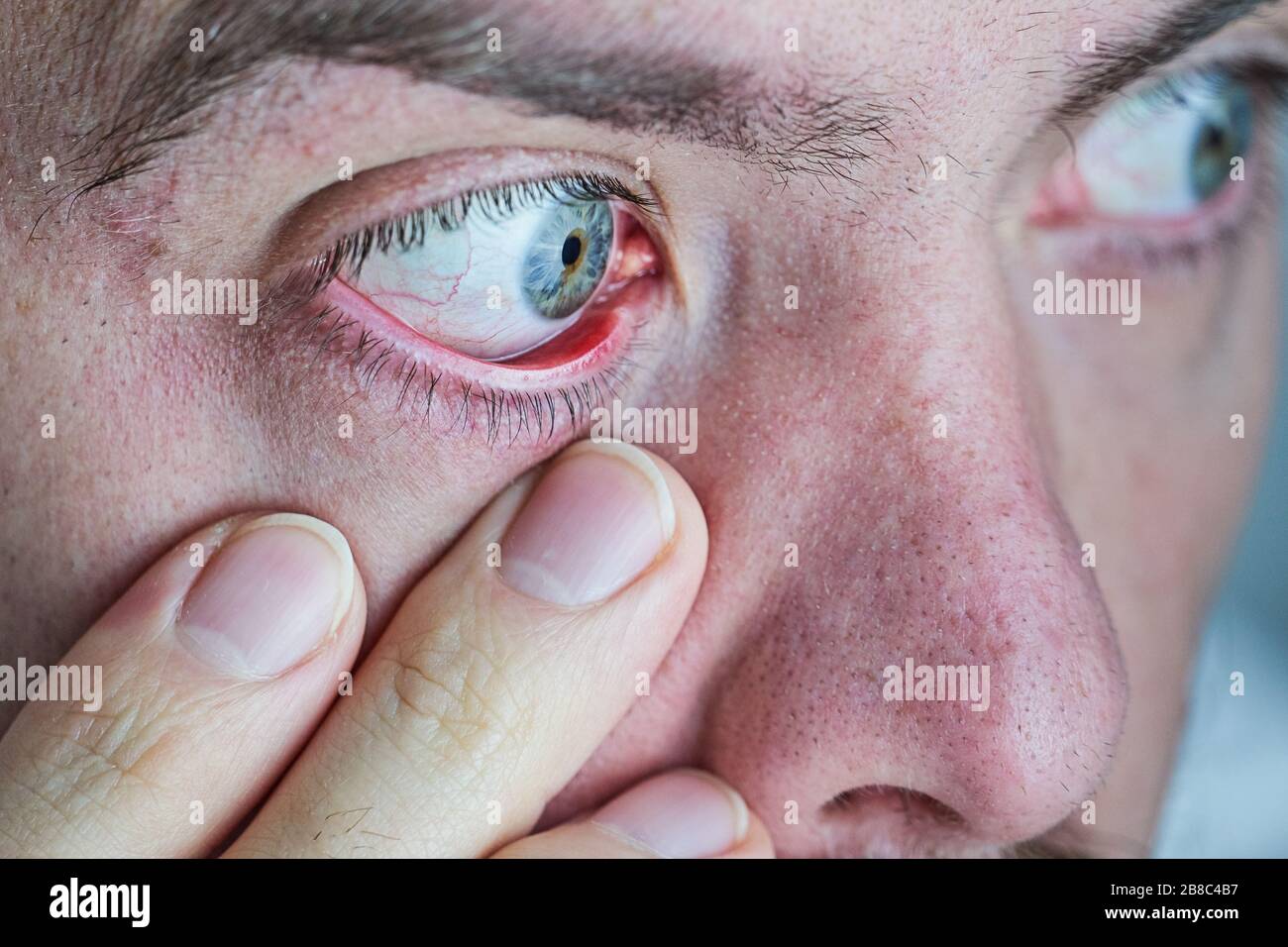 Yeux Secs Banque D Image Et Photos Alamy