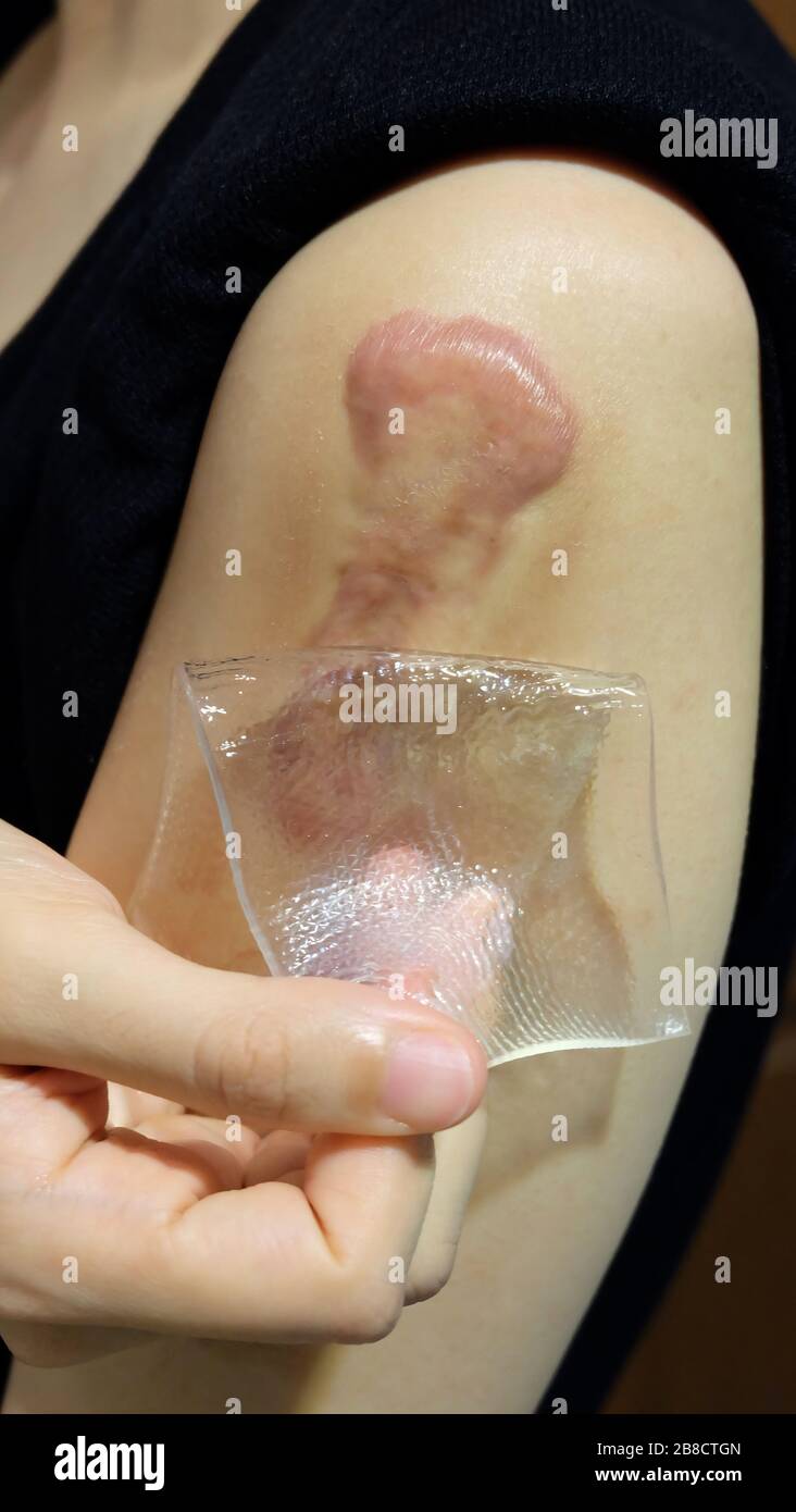 Décollement d'une feuille de gel de silicone à l'écart d'une cicatrice rouge de keloïde sur le bras. Banque D'Images
