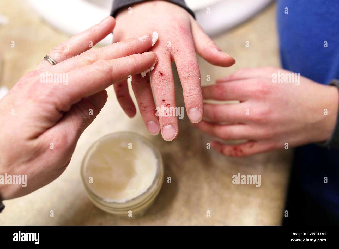 Une mère met de la lotion hydratante sur les mains d'un enfant avec une peau très sèche et fissurée. Banque D'Images